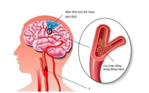 پاورپوینت سکته مغزی (CVA)